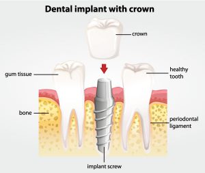 Implants dental implants