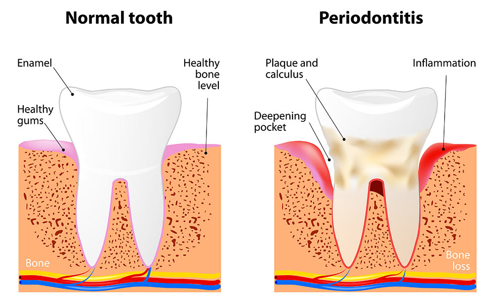 LASER-GUM-DISEASE