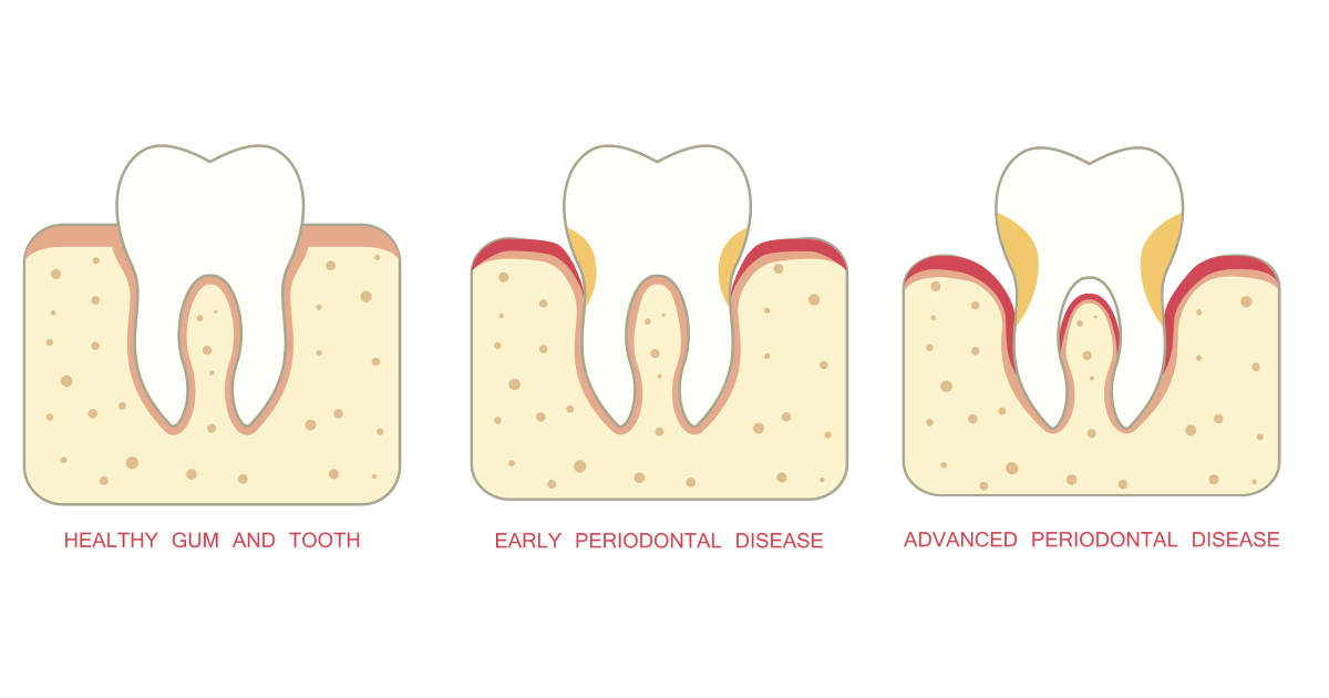 Keep your gums healthy