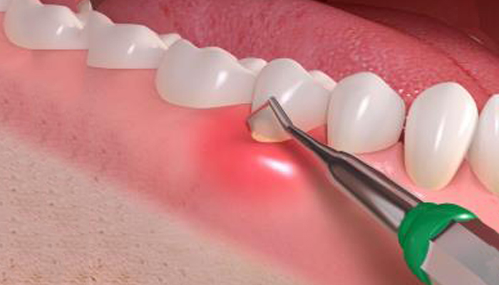 most common cause of tooth loss in adults is?