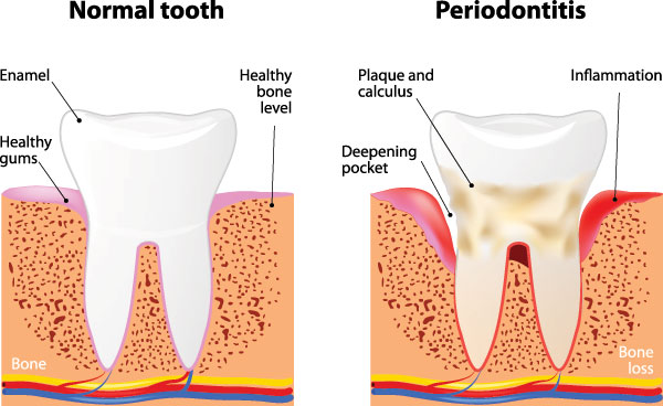 Periodontitis is the most common cause of tooth loss in adults 