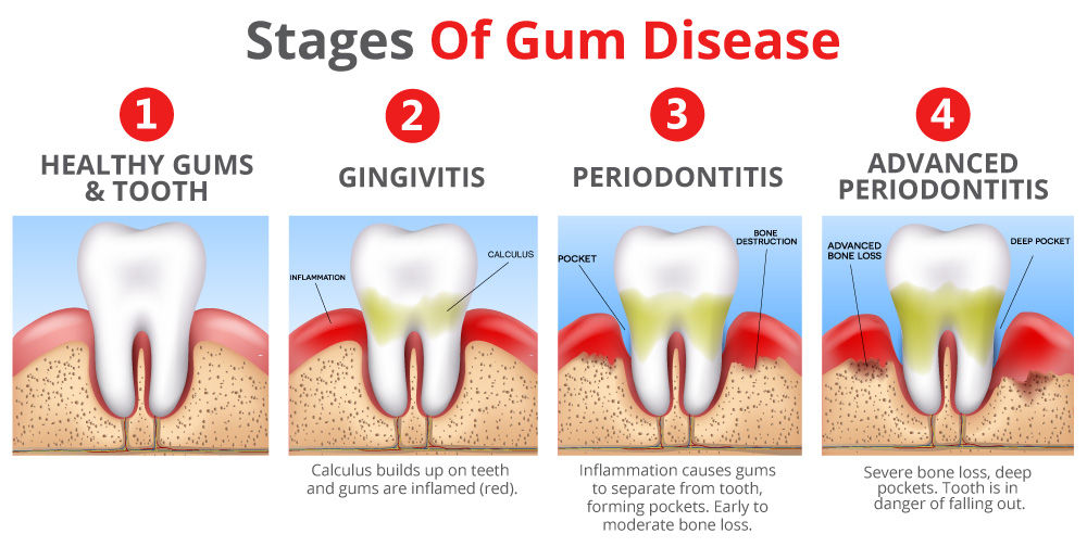 Most common cause of tooth loss in adults