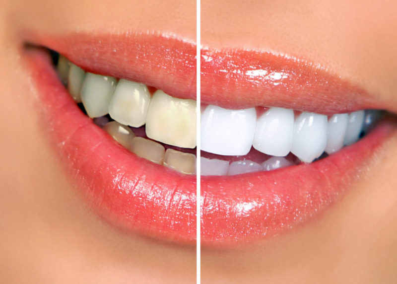 how to get a whiter smile in Highlands Ranch, Colorado.